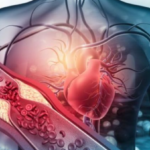 What is high cholesterol picture of heart and blood